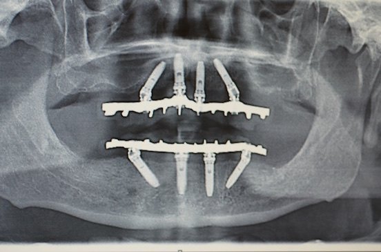 All-on-4 ortopantomografia finale