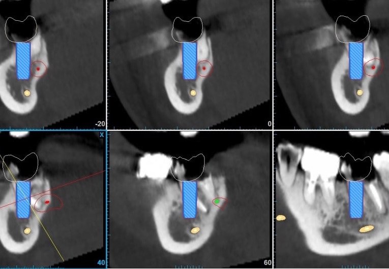 impianti dentali: progettazione vista implantocentrica