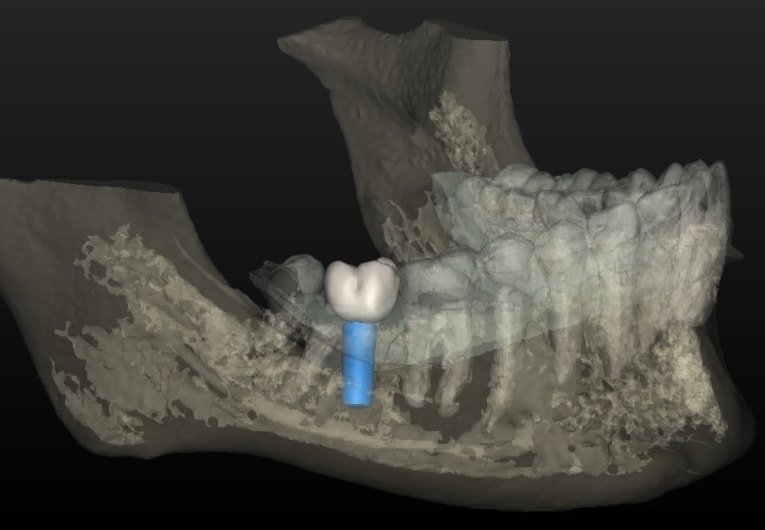 impianti dentali: progetto finale