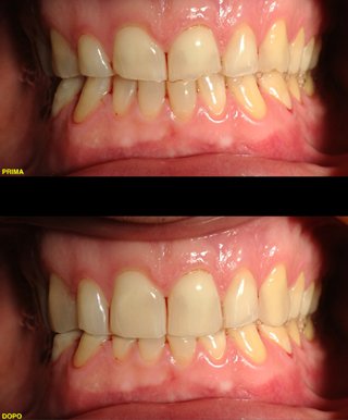 progetto di faccette dentali in ceramica per migliorare l'estetica del sorriso